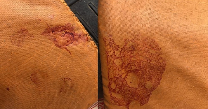 В переславской больнице врач испачкала чужой кровью двухлетнюю девочку